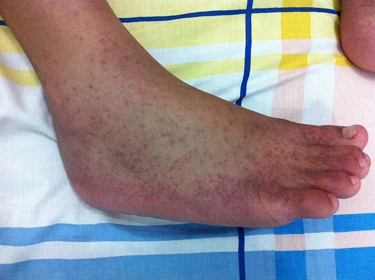Чикунгунья Чыкунгунья Chikungunya